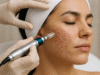 Micro Needling for Acne Scars: Does It Really Work? Micro Needling for Acne Scars: Does It Really Work?