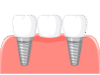Dental Bridge: How to Avoid Common Problems Dental bridge