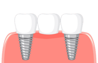 Dental Bridge: How to Avoid Common Problems Dental bridge