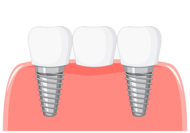 Dental bridge