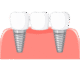 Dental Bridge: How to Avoid Common Problems Dental bridge