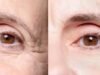 Bid Farewell to Eye Wrinkles: Top Effective Treatments for 2025