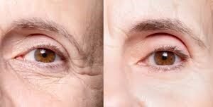 Bid Farewell to Eye Wrinkles: Top Effective Treatments for 2025