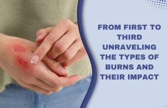 Types of Burns: How to Recognize and Treat Them Effectively burns