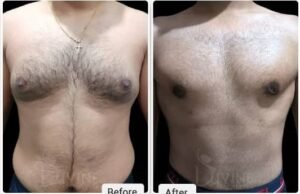 Benefits of Male Chest Fat Surgery in Islamabad for a Toned Physique Male chest fat surgery in Islamabad