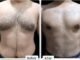 Benefits of Male Chest Fat Surgery in Islamabad for a Toned Physique Male chest fat surgery in Islamabad