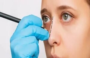 Rhinoplasty for a Natural Look: Enhancing Without Overdoing It Rhinoplasty in Riyadh (2)