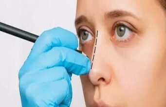 Rhinoplasty for a Natural Look: Enhancing Without Overdoing It Rhinoplasty in Riyadh (2)