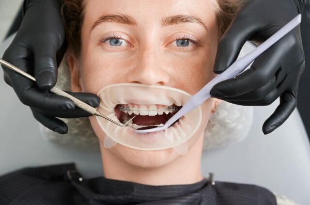 Teeth gap filling
