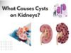 What Causes Cysts on Kidneys? What Causes Cysts on Kidneys