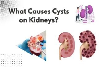 What Causes Cysts on Kidneys? What Causes Cysts on Kidneys
