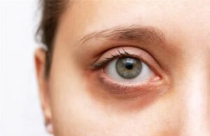 What Is the Best Dark Circles Treatment? What Is the Best Dark Circles Treatment