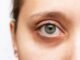 What Is the Best Dark Circles Treatment? What Is the Best Dark Circles Treatment