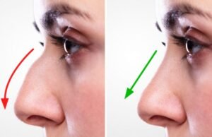 Why More People Are Choosing the Best Rhinoplasty in Islamabad for Nose Enhancement best rhinoplasty in islamabad