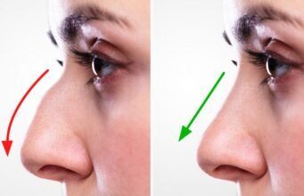 Why More People Are Choosing the Best Rhinoplasty in Islamabad for Nose Enhancement best rhinoplasty in islamabad