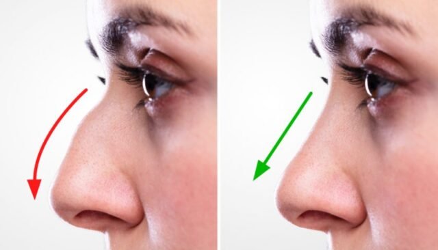 best rhinoplasty in islamabad