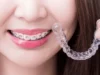 What is the price of Invisalign braces in Singapore? Invisalign braces