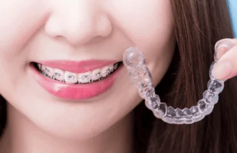 What is the price of Invisalign braces in Singapore? Invisalign braces