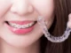 What is the price of Invisalign braces in Singapore? Invisalign braces