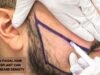 How a Facial Hair Transplant Can Boost Beard Density facial hair transplant