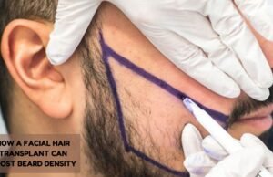 How a Facial Hair Transplant Can Boost Beard Density facial hair transplant