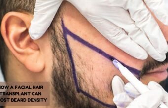 How a Facial Hair Transplant Can Boost Beard Density facial hair transplant