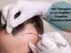 Hair Transplant in Los Angeles: A Complete Procedure Guide hair transplant los angeles