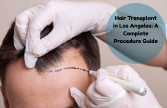 Hair Transplant in Los Angeles: A Complete Procedure Guide hair transplant los angeles