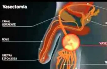 Vasectomy and Heat Shock Protein Overexpression