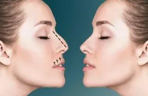 How to Choose the Best Surgeon for Your Rhinoplasty Surgery in Riyadh Rhinoplasty surgery in Riyadh